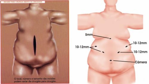 Cirurgia convencional (E), com corte abdominal e de recuperação mais lenta, e incisões da videolapar - 